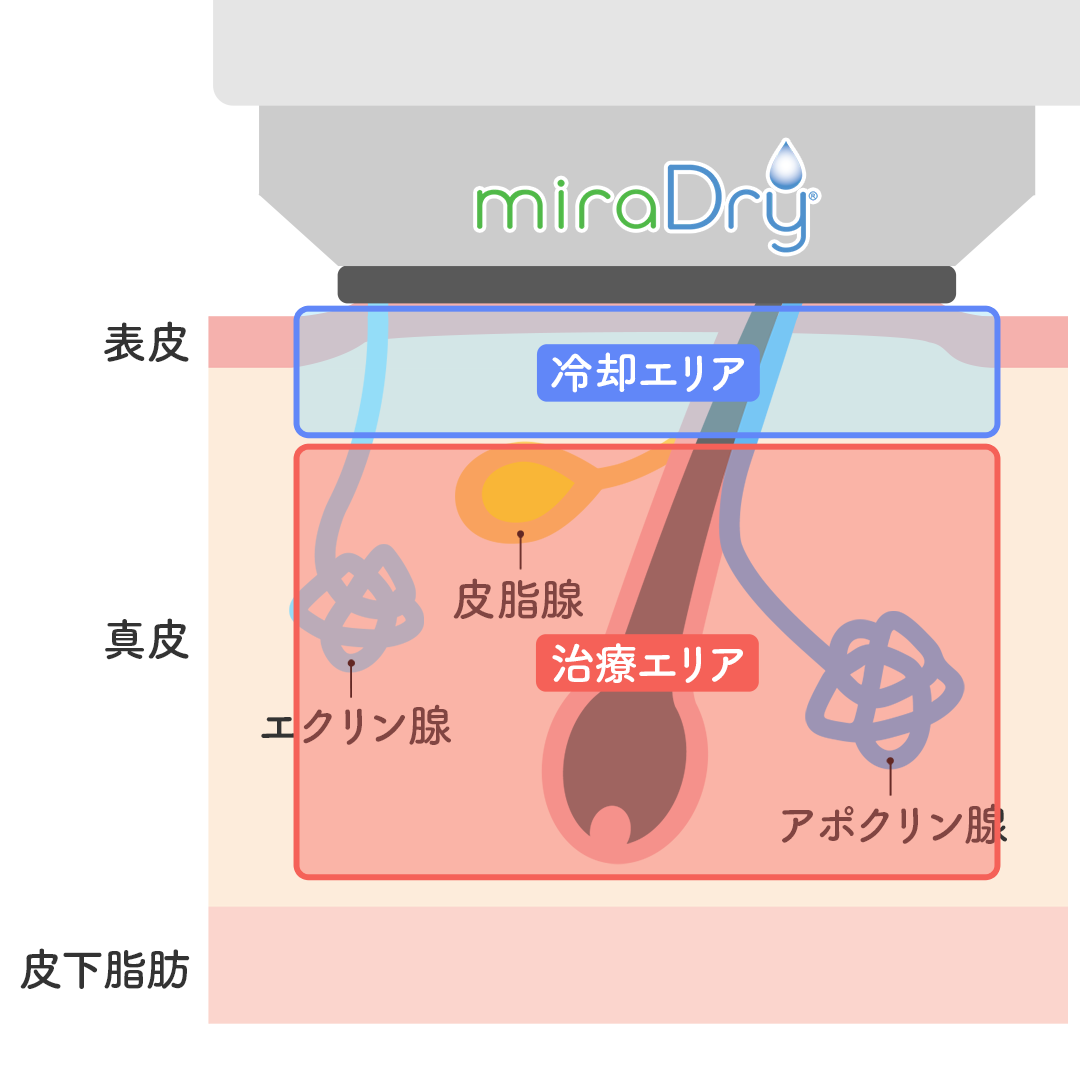 マイクロ波の照射中は、冷却システムにより肌の比較的浅い層は守られている